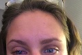 Laura dostala infekciu oka, takmer naň nevidí: Podľa lekárov je za tým kozmetická taštička!