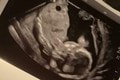 Tehotnej žene povedali, že jej dieťatko zomrelo v maternici: Na to, čo nasledovalo, lekári nikdy nezabudnú