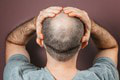 Vďaka transplantácii vlasov prišli vedci na niečo prelomové: V čom môžu pomôcť vlasové cibuľky?