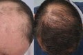 Už žiadne lámanie a vypadávanie vlasov: Prelomová liečba je teraz k dispozícii!