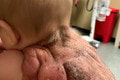 Bábätko sa narodilo so vzácnou kožnou poruchou: Na chrbte mu vyrástol pancier