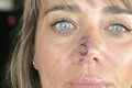 Z obyčajnej vyrážky sa vykľula smrteľná choroba: Žena pri operácii takmer prišla o nos