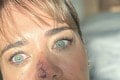 Z obyčajnej vyrážky sa vykľula smrteľná choroba: Žena pri operácii takmer prišla o nos