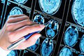 Nová diagnostika pomôže v liečbe Alzheimera