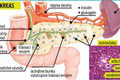 Unikátny zákrok lekárov v košickej nemocnici: Diabetičke transplantovali bunky pankreasu!