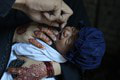 Pakistan sa pustil do masívnej očkovacej akcie: Chcú chrániť budúce generácie