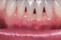 Zubárka radí: Máte čierne trojuholníčky medzi zubami? Znamená to jedinú vec!