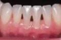 Zubárka radí: Máte čierne trojuholníčky medzi zubami? Znamená to jedinú vec!