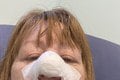 Z vyšetrenia u zubára sa vykľula operácia nosa: Hrozivá diagnóza! Pozrite sa, čo má teraz na tvári