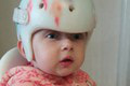 Bojovníčka Milotka: Nosila helmu, aby prežila! Ako žije dievčatko s raritným ochorením?