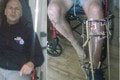 Nicholas pred 10 rokmi havaroval a ostala mu VISIEŤ noha: Fakt mu TOTO povedali lekári?!