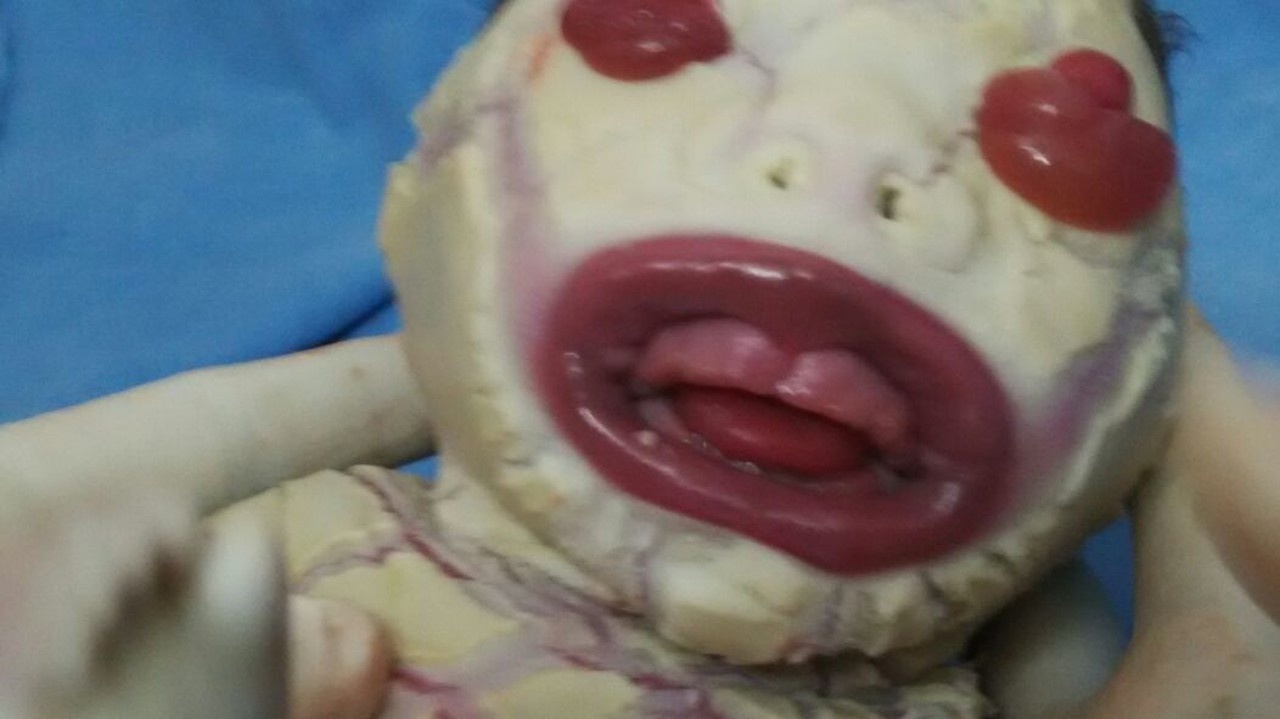 Dieťatko sa narodilo bez kože.