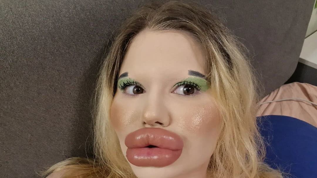 Andrea chce mať väčšie lícne kosti. 