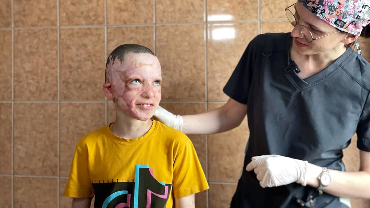 Mal popálených 45 % tela.