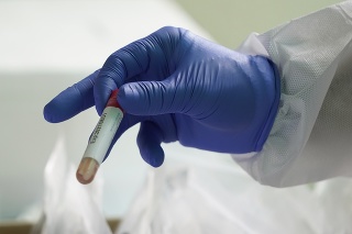 Zdravotník drží testovaciu banku na testy na koronavírus.