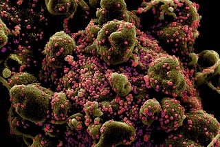 Detailný pohľad na apoptotickú bunku ťažko infikovanú novým typom koronavírusu