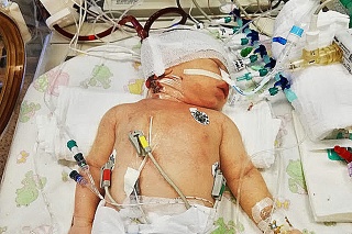 Malá bojovníčka Emmka mala po narodení poškodené pľúca.