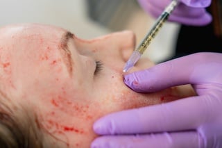 Close-up photo of doctor applying blood plasma during PRP vampire facelift.
