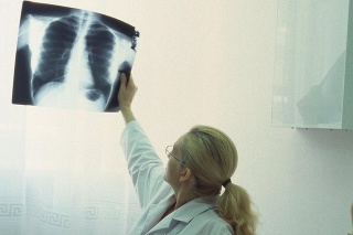 Nakazená žena nemala typické príznaky TBC (ilustračné foto).
