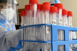 Koronavírus na Slovensku: Takto vyzerajú odobrané vzorky na testovanie.