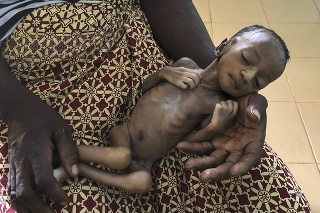 Matka drží svoje podvýživené dieťa v nemocnici v Hounde na juhozápade Burkiny Faso.