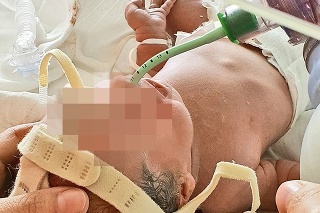 Matúškovi po narodení dali kyslík, no onedlho už dýchal sám. 