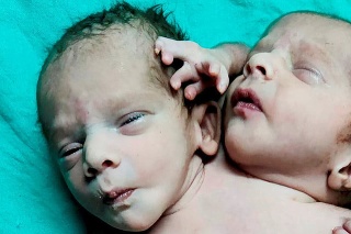 Stále nie je jasné, či ide o jedno bábätko alebo siamské dvojčatá.