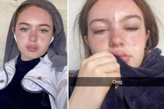 Emma v príspevku na TikToku uviedla, že namiesto slnkom pobozkanej pokožky jej koža pripomínala “otravu” slnkom. 