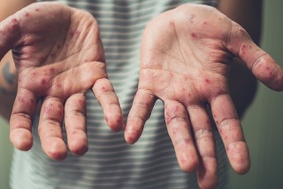 A young man is showing his hands with spots and rash from hand foot and mouth disease