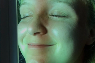 Emma skončila po návšteve solária s popáleninami a pľuzgiermi na tvári.