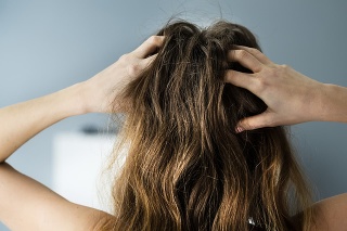 Itching Dry Head Scalp And Long Hair With Dandruff