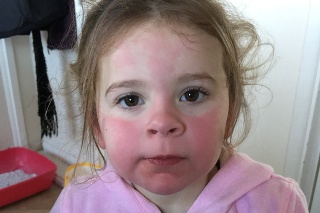 10-ročná Summer-Angel má alergiu na chlad, ktorá jej spôsobuje svrbivé vyrážky a žihľavku.
