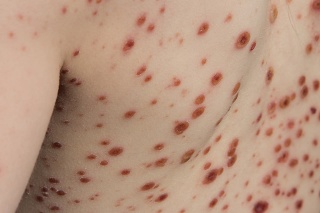 Chickenpox is an infectious disease. It causes a spotty itchy rash on the body. Some people have a few spots while others can have a lot. The spots fill with a fluid under the top layer of the skin creating bubble-like sac vesicles. These blisters eventually turn into scabs.
