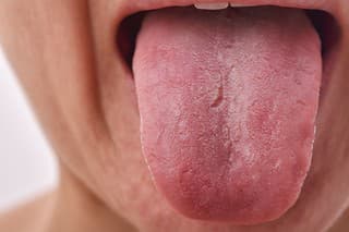 Tongue problem disease, Fissured white tongue, Unhealthy oral care hygiene.