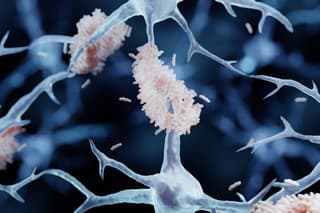 Ilustrácia Alzheimerovej choroby - amyloidné plaky sú nesprávne poskladané proteínové agregáty medzi neurónmi.
