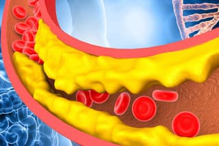 Vysoký cholesterol