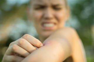 close up of a red mosquito bite on a person's arm, rubbing and scratching it outdoor in the park.