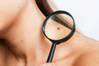 Close-up of a big mole on a young woman's neck magnified with a magnifying glass isolated on a gray background. The effect of sunlight on the skin