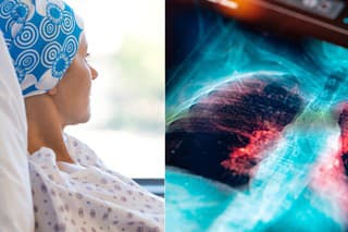 Rakovinu pľúc je v prvotnom štádiu náročné odhaliť. (ilustračné foto)