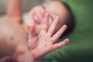 Boy with symptoms hand, foot and mouth disease