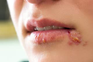 Girl lips showing herpes blisters