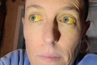 Amber si všimla, že náhle sa jej oči a koža začali sfarbovať na žlto.