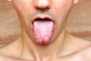 Disease infection tongue, throat a man