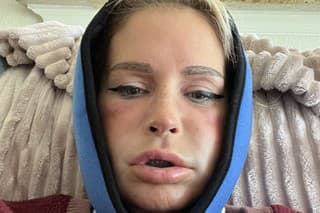 Deň po vložení implantátov jej opuchla tvár a na druhý deň sa začali tvoriť modriny.