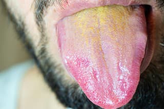 Male mouth with protruding tongue with a yellow coating at the base