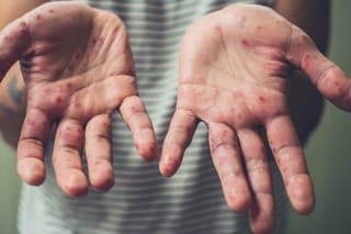 A young man is showing his hands with spots and rash from hand foot and mouth disease