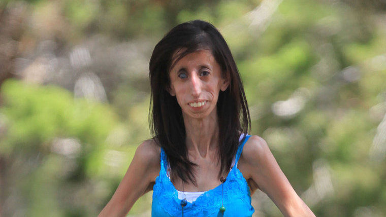 Lizzie Velasquez si nedá svoj optimizmus vziať.