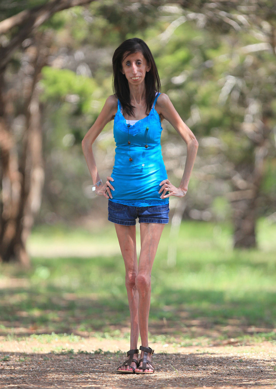 Lizzie Velasquez si nedá svoj optimizmus vziať.