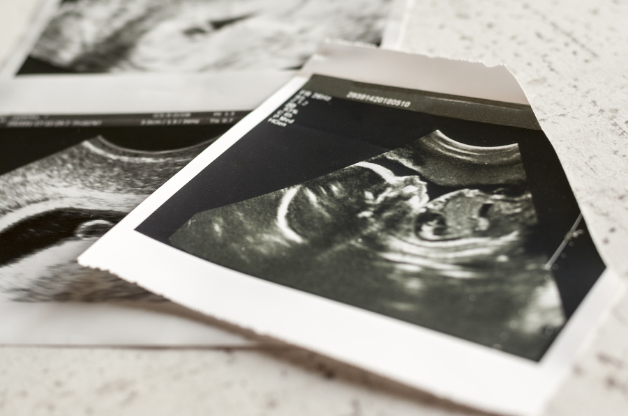 Photographs of ultrasound of