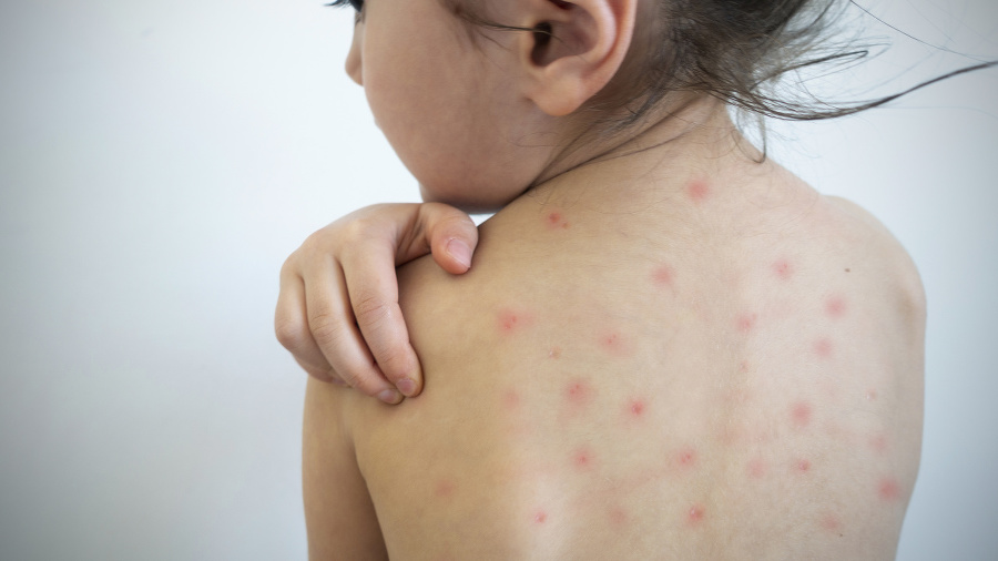 Young girl with measles